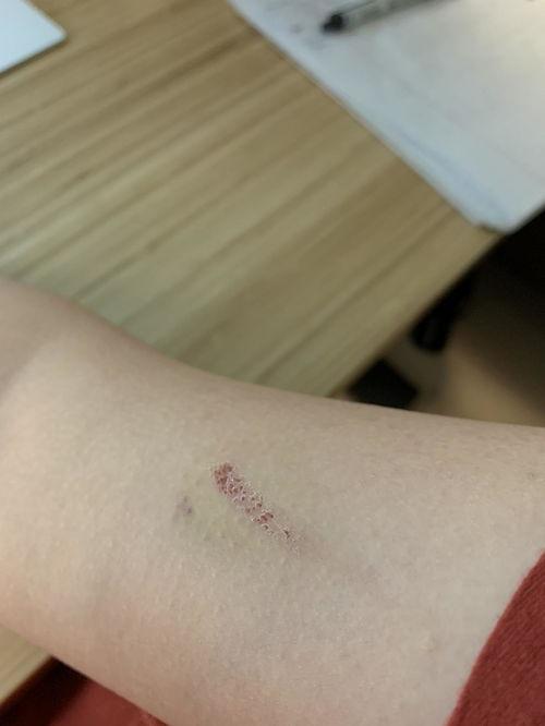 手臂擦伤图片,手臂擦伤急救与护理攻略
